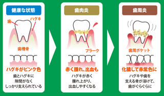 歯周病と歯肉炎の違い