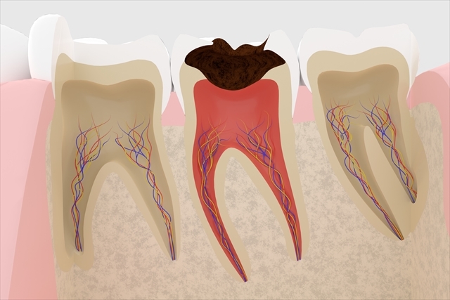 虫歯の段階別の症状や治療法とは？押さえておきたい予防法も解説