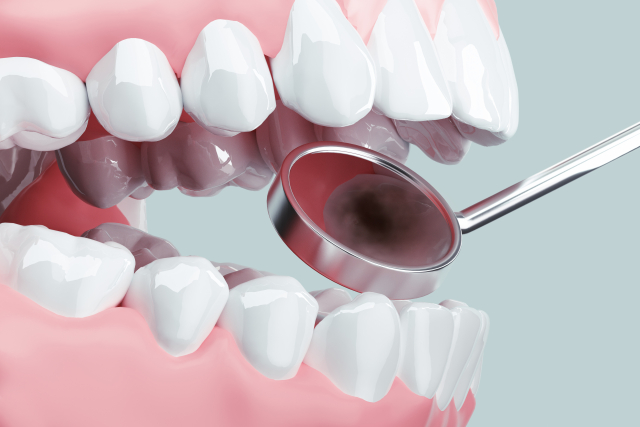 歯周病と虫歯の違い｜押さえておきたいそれぞれの原因・症状・治療法